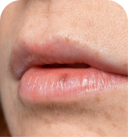 Herpes labialis treatment